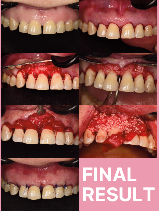 Guided Tissue Regeneration